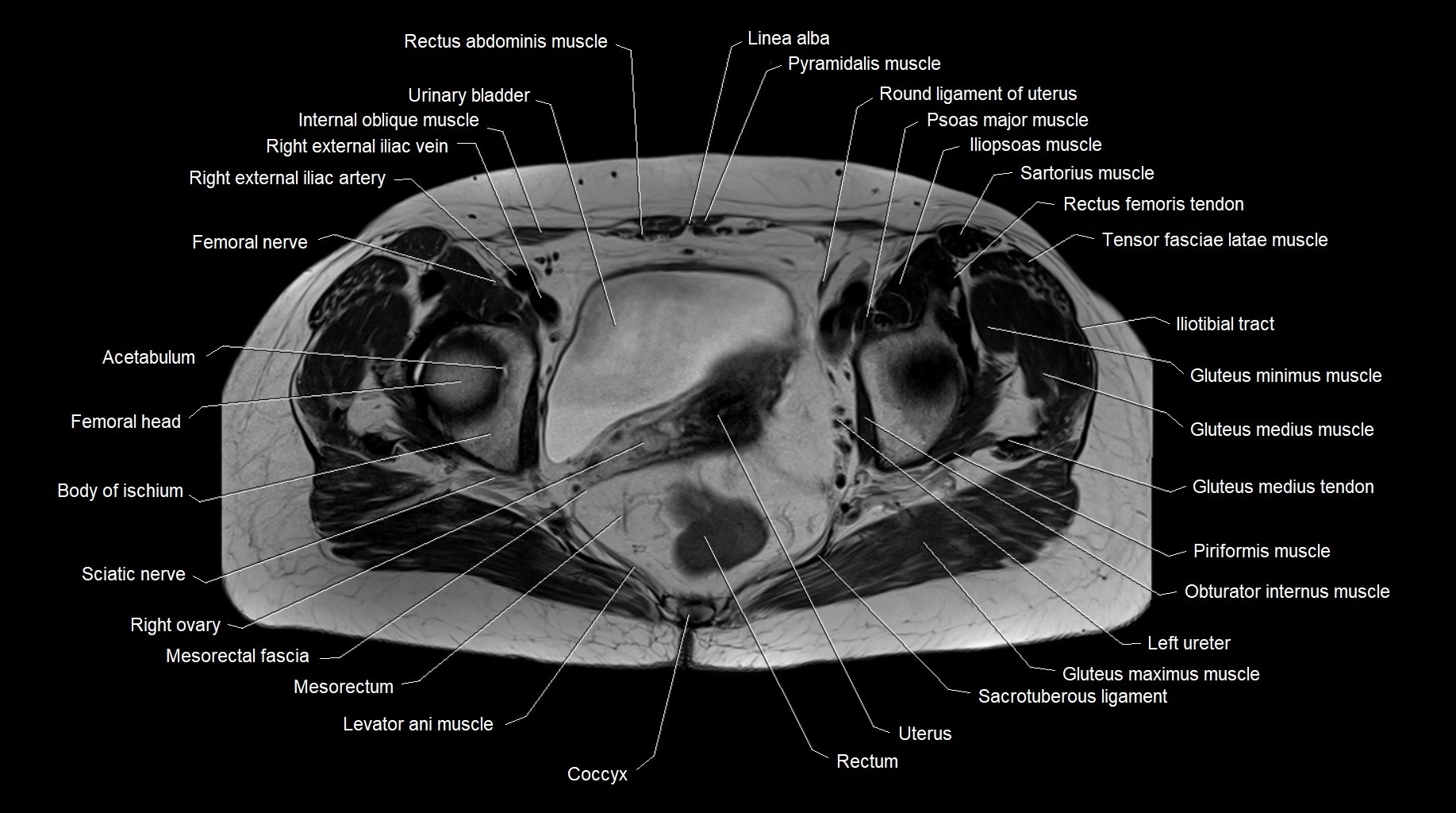 MRI 3T pelvis axial cross section anatomy image 20.webp